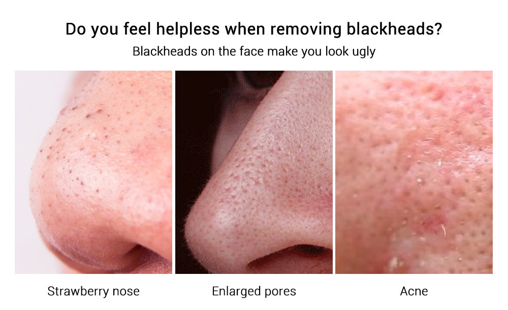 LANBENA Blackhead Remover Strips