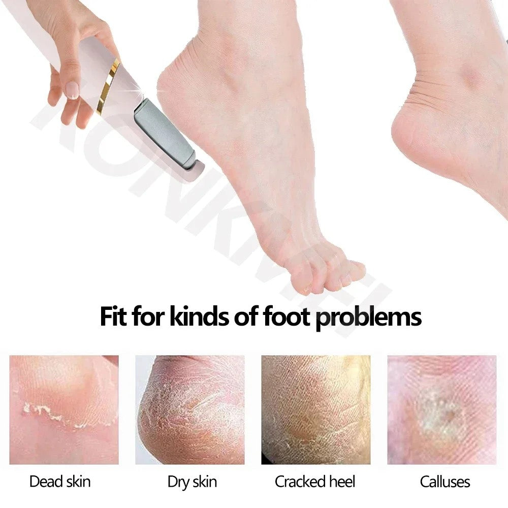 Pedi-Perfect™  Foot File and Callus Remover